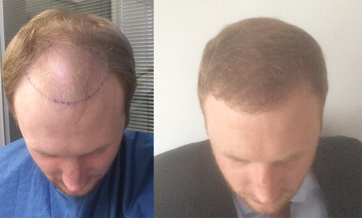 FUE hair transplant