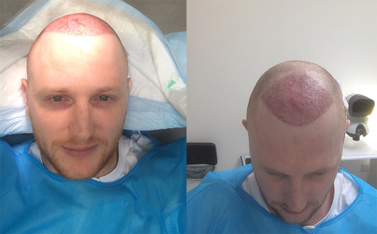 during hair transplant