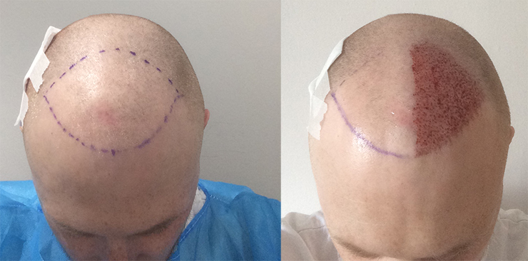 hair transplant procedure