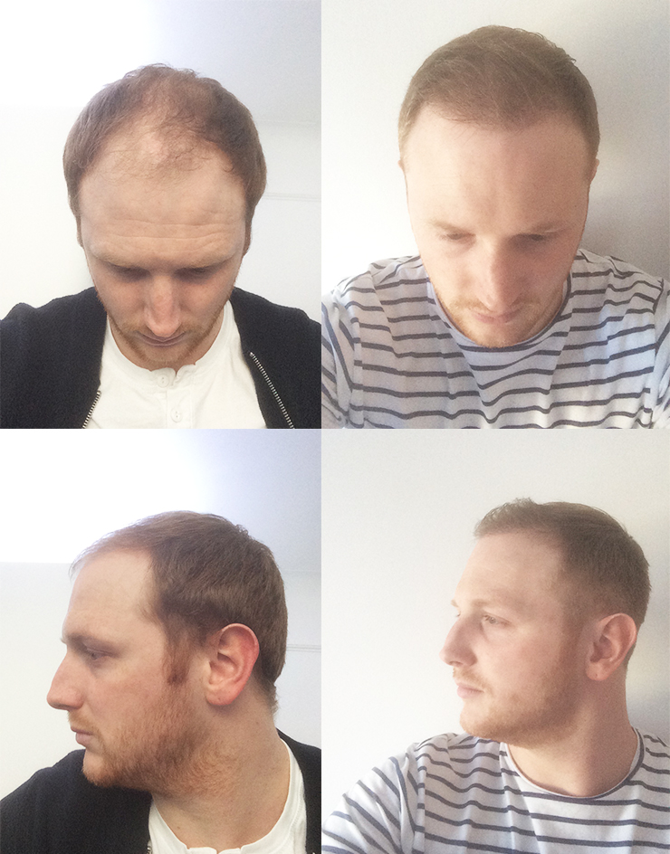 james before after hair transplant