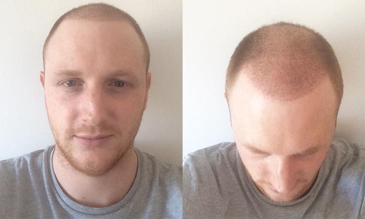 week after hair transplant